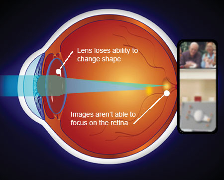 Presbyopia